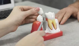 What Makes Dental Implants So Popular for Smile Restoration in Washington, DC?