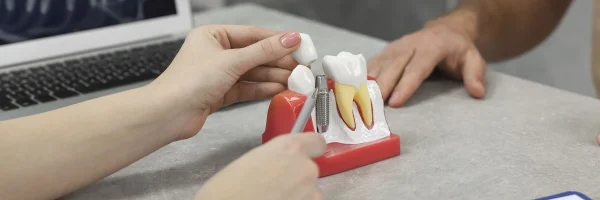 What Makes Dental Implants So Popular for Smile Restoration in Washington, DC?